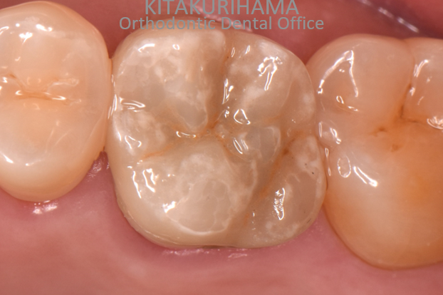 歯 の 亀裂 治療